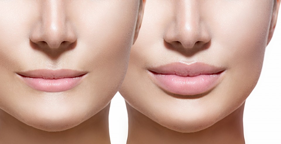 lip_augmentation_toronto_before_after